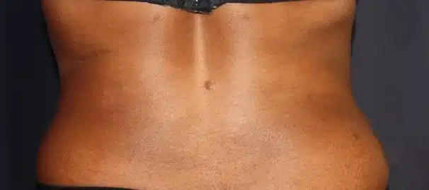 SculpSure