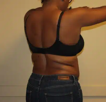 SculpSure