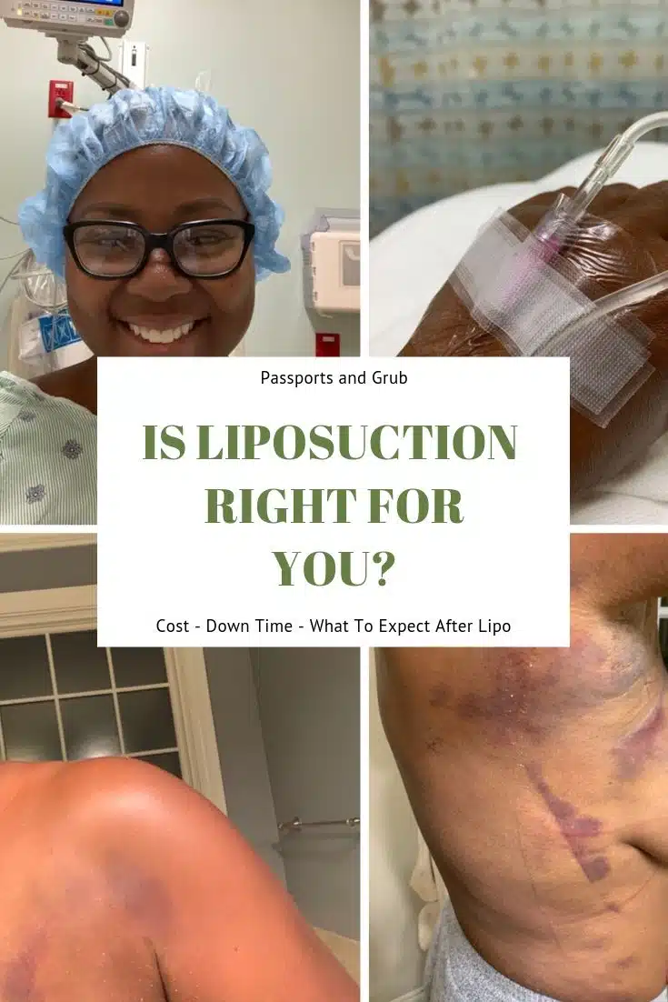 Liposuction Results
