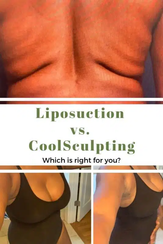 Sculpsure vs. Coolsculpting