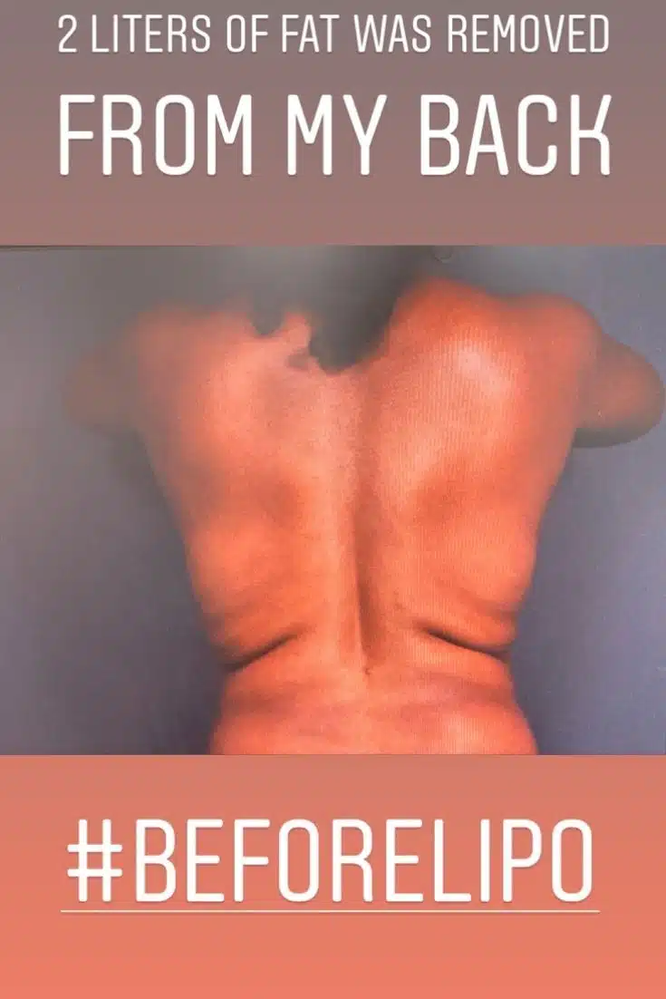 pre liposuction back fat